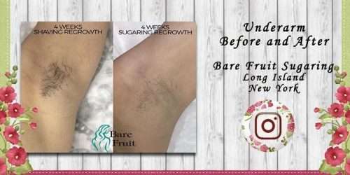 Comparison of underarm hair removal results, highlighting the effectiveness of sugaring.