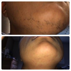 Review of Sugaring Paste Hair Removal – Thicker Hair, Natural Sugaring 16 Oz tub Fragrance Free Silicone Free by Private User 48